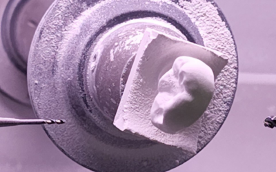 Tooth Cap Solutions in Newmarket