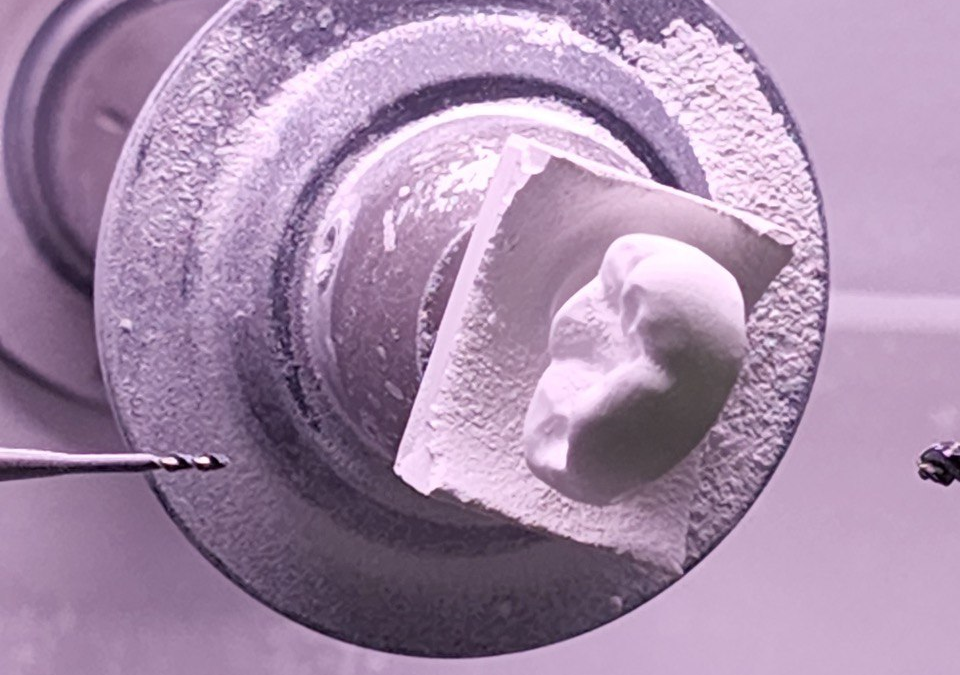 Tooth Cap Solutions in Newmarket